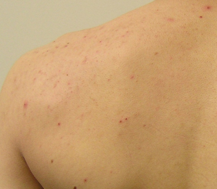 Acne Treatment